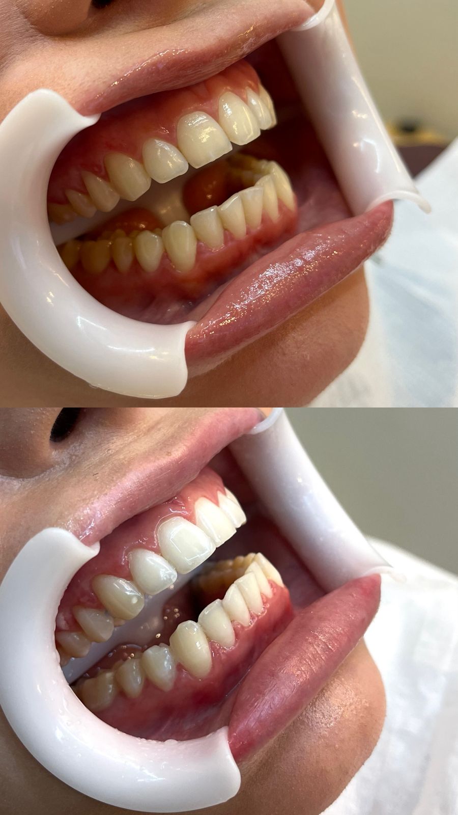 Comparativo do sorriso antes e depois do clareamento dental