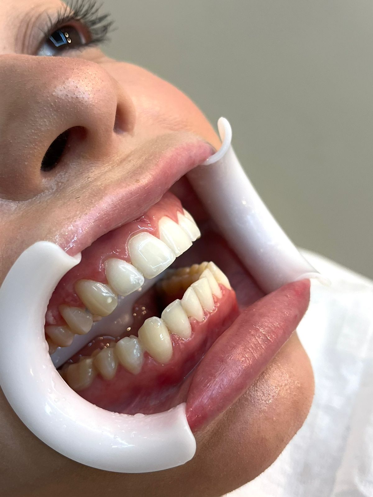 Resultado de clareamento dental em close